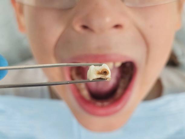 Best Emergency Treatment for Dental Infections or Abscesses in Del Norte, CO